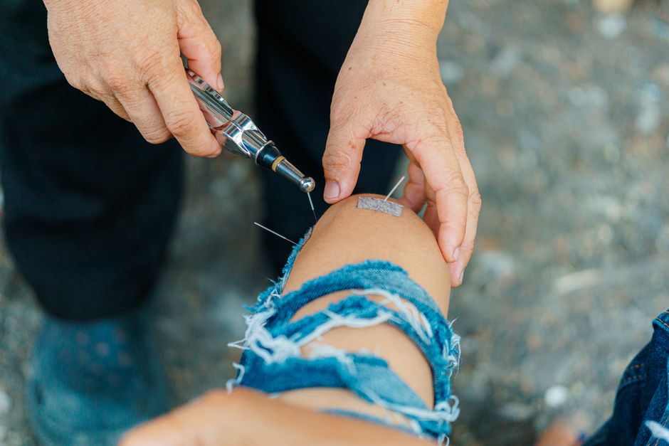 Close-up of acupuncture treatment on a person's knee outdoors, emphasizing natural healing.